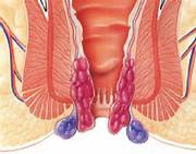 ANAL BÖLGE AMELİYATI SONRASI YAPILACAKLAR