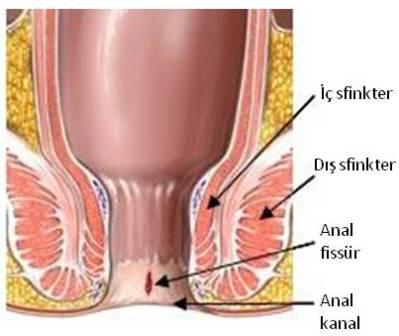 ANAL FİSSÜR İÇİN YAPILACAKLAR